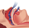 Sleep Apnea